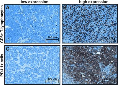 Merkel Cell Polyoma Viral Load and Intratumoral CD8+ Lymphocyte Infiltration Predict Overall Survival in Patients With Merkel Cell Carcinoma